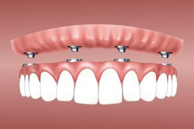 overdenture 3597628_640 1