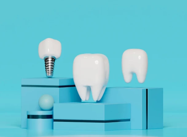 Les 5 questions les plus fr&eacute;quentes sur les implants dentaires