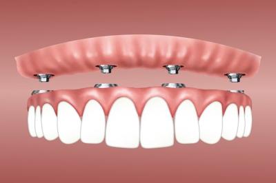 implant dentaire - dentiste bretigny